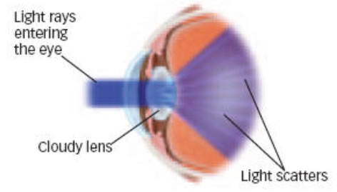 Rays entering eye with cataract